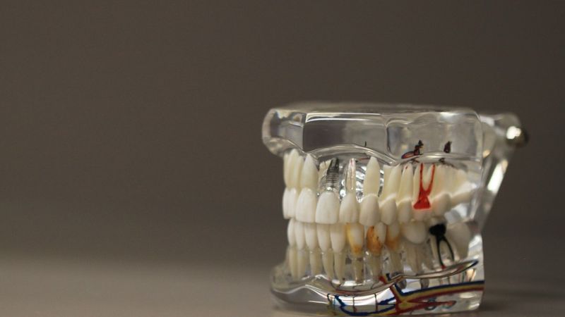 Зубы мудрости: нужно ли их лечить или лучше сразу удалять