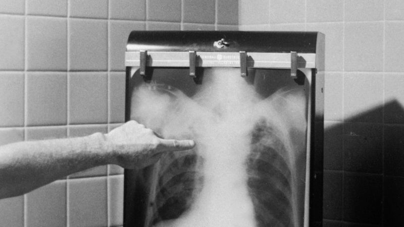 Туберкулез выявили у сотрудника детсада в Петропавловске ᐈ новость от ...